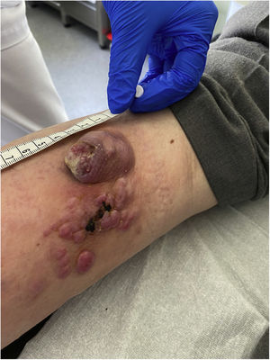 Skin lesion on the posterior face of the right leg identified in first medical visit that triggered suspicion of skin tumor.