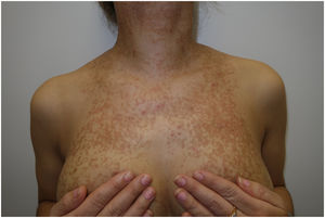 Papuloplacas eritematomarronáceas, algunas con aspecto pseudovesiculoso, confluyentes con patrón reticulado en región pectoral anterior y cervical.