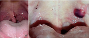 A) Vesícula hemorrágica de 4mm en la úvula. B) Ampolla de unos 0,5cm en paladar blando, acompañada de petequias y equimosis.