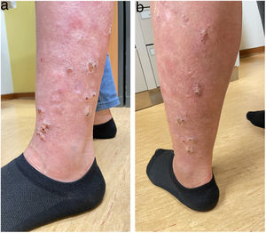 Verrucous erythematous lesions in the left lower limb, with a linear pattern along Blaschko