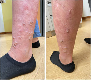 Verrucous erythematous lesions in the left lower limb, with a linear pattern along Blaschko's lines.