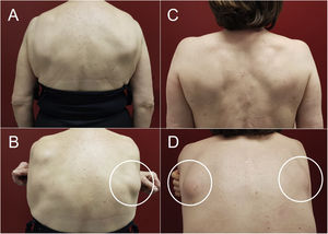 Aspecto clínico de un ED unilateral (A y B) y bilateral (C y D). Se observa la aparición de las tumoraciones (círculos blancos) al hacer antepulsión y aproximación de los hombros.