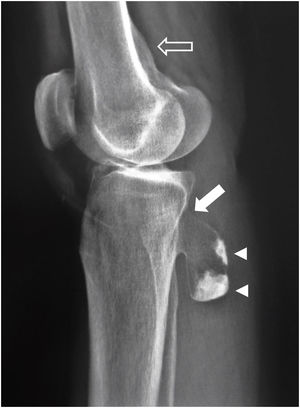 Radiografía lateral de rodilla. Se observa el aspecto típico de un osteocondroma pediculado de la cara posterior de la metáfisis proximal de la tibia, prolongando el tejido óseo cortical y esponjoso de esta (flecha llena). En el interior de la lesión se identifican dos zonas de predominio escleroso y bordes bien definidos en la proximidad de su borde periférico (puntas de flecha), que parece regular y también bien definido. No hay reacción perióstica, calcificaciones periféricas ni aparente masa de partes blandas. En la cara posterior de uno de los cóndilos femorales se observa una irregularidad cortical (desmoide cortical) (flecha hueca).