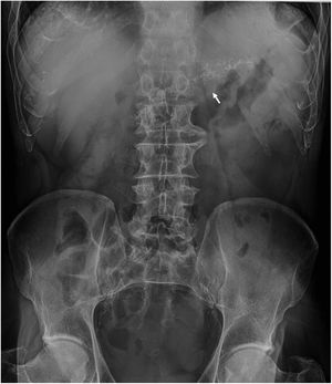 Radiografía simple de abdomen con imágenes compatibles con calcificaciones (flecha) que corresponde a la silueta pancreática.