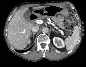 Corte transversal de la TC abdominal con calcificaciones en la silueta pancreática.