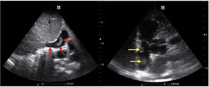Ecocardiografía clínica a pie de cama. En la imagen de la izquierda se evidencia trombo en la vena cava inferior que incluso se extiende hasta la aurícula derecha como indican las flechas rojas, desde un plano subcostal en ventana subxifoidea. En la imagen de la derecha se visualizan dos trombos en tránsito en la aurícula derecha señalados con las flechas amarillas, desde un plano apical de dos cámaras en ventana apical.