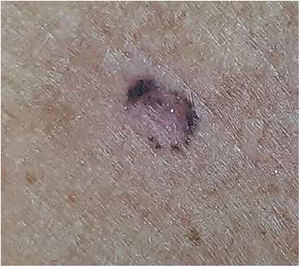 Caso 1. Imagen macroscópica: lesión macular de 8mm de bordes pigmentados en forma de áreas radiadas.