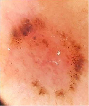 Caso 1. Imagen dermatoscópica: estructuras en forma de hojas de arce periféricas.