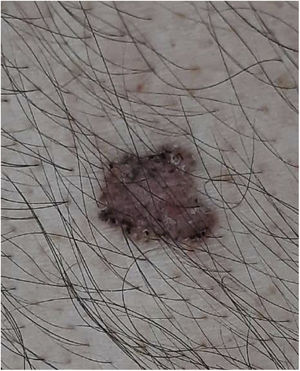 Caso 2. Imagen macroscópica: lesión macular eritematosa de 8mm de bordes pigmentados.