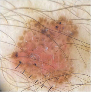 Caso 2. Imagen dermatoscópica: estructuras en forma de rueda de carro, hojas de arce periféricas y nidos ovoides.