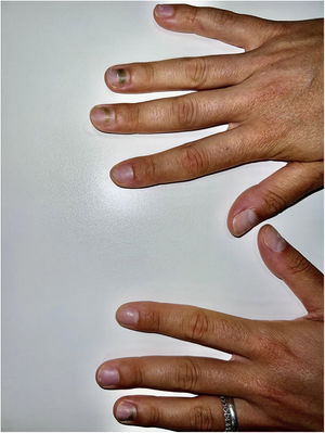 Overview of both hands showing greenish coloration of the nail plate of fourth nail on the left hand and of third and fourth nails on the right hand.