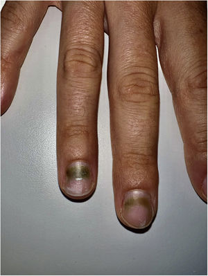 Detail of the third and fourth digits of the right hand showing yellowish-greenish discoloration with associated laterodistal onycholysis of the latter.