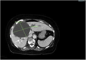 AngioTAC abdominal que muestra gran lesión quística hepática, que ejerce efecto de masa sobre la bifurcación portal y produce dilatación de la vía biliar intrahepática.
