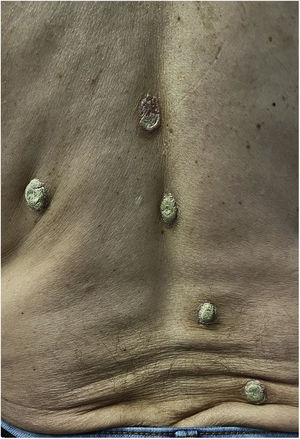 Various hyperkeratotic plaques with a limpet shell appearance in the back of a 58-year-old male.