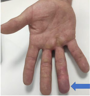 Cianosis en el pulpejo y en el tercio medio del cuarto dedo.