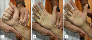 Test de Allen. A)Compresión de arteria radial. B)Palidez completa de la mano. C)Revascularización tras el fin de la compresión de la arteria radial.
