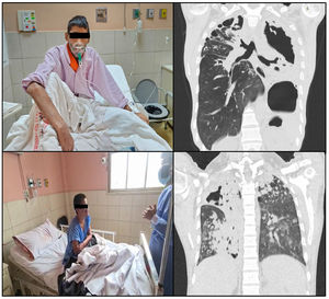 Paciente de nuestra institución y con importantes secuelas por tuberculosis Paciente de 33 y 37 años dependientes de oxígeno.
