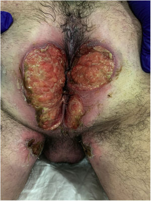 Foto original del paciente previo consentimiento. Aspecto inicial de las úlceras perianales del caso.