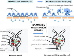 Corte histológico renal con hematoxilina-eosina que muestra glomérulos y túbulos en un riñón normal. Esquema de los compartimentos de la nefrona. Los glomérulos se muestran rodeados de un círculo negro. Los glomérulos constituyen el compartimento vascular de la nefrona. En el riñón normal el espacio que hay entre los glomérulos está constituido por túbulos que no dejan espacio entre ellos (espacio virtual). Se muestra un ejemplo en la parte superior derecha de la imagen, extrapolable a toda la muestra. El espacio que ocupan todos los túbulos es el compartimento túbulo-intersticial.