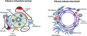 Esquema de los mecanismos de progresión renal: esclerosis glomerular.