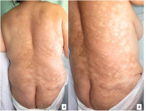 Imagen en la que se puede observar patrón reticular compuesto de eritema e hiperpigmentación alternados con áreas blanquecinas. Se extiende desde parte dorsal alta hasta parte superior de glúteos (A), en una imagen oblicua derecha se aprecia con mayor detalle el patrón reticular (B). Llama la atención la gran superficie por la que se extienden las lesiones.