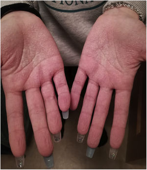 Queratodermia acuagénica: manos de nadador y erupción súbita bilateral tras contacto breve con agua.