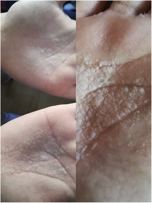 Queratodermia acuagénica, día 4 (izquierda): pápulas y placas en las palmas de las manos; y día 8: rotura de pápulas y descamación.