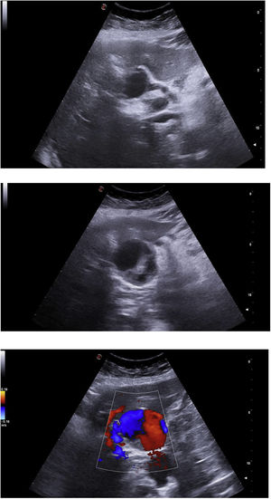 Ecografía dúplex de aneurisma de arteria hepática. Se puede apreciar una lesión hipoecoica en el recorrido de la arteria hepática (imagen superior) con la sonda convexa en posición transversal en epigastrio, con contenido heterogéneo en su interior (imagen central), presentando flujo anterógrado y retrógrado mediante Doppler color (imagen inferior) correspondiente al saco aneurismático con la misma sonda y posición con movimientos de inclinación.