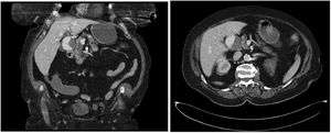 TC abdominal con contraste en fase arterial donde se aprecia aneurisma sacular de la arteria hepática con trombo mural excéntrico en su interior, visto en cortes coronales (imagen izquierda) y axiales (imagen derecha).