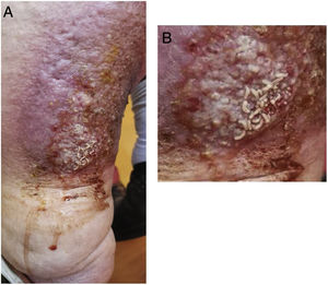 Venous ulcer of the left lower limb infested by larvae (A) and detail of the affected area (B).