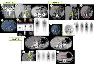 Caso 1. A) AngioTC de TSA corte coronal donde se visualizan múltiples lesiones saculares compatibles con paragangliomas cervicales. B) TC de abdomen corte coronal y axial donde se visualizan nódulos hipervasculares de localización paraaórtica e interaortocava. C y D) PET-TC DOPA con captación patológica de los nódulos. E) Gammagrafía I-131-MIBG. Captación patológica de los nódulos retroperitoneales. Caso 2. A) TC de abdomen con contraste i.v. en fase portal corte axial y coronal donde se visualiza nódulo adyacente a la glándula suprarrenal derecha y vena cava inferior. B) TC de abdomen con contraste i.v. en fase portal donde se visualizan adenomas suprarrenales bilaterales. C) Estudio PET-TC DOPA con captación patológica de la lesión. D) Gammagrafía con I-131-MIBG donde no se visualiza depósito patológico del trazador. Caso 3. A y B) TC de abdomen con contraste i.v. en fase arterial y portal con cortes axiales y coronales, donde se visualiza una lesión hipervascular adyacente al segmento I hepático. C) Gammagrafía con I-131-MIBG donde se visualiza captación de la lesión descrita. D) TC de abdomen con contraste i.v. en fase portal donde se visualizan clips quirúrgicos tras la extirpación de la lesión.