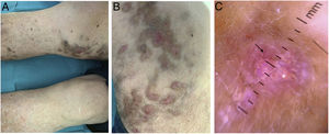 A. Lesiones nodulares de coloración eritematosa con halo y base parduzca, con tendencia a agruparse, en la cara medial de rodilla derecha, con alguna lesión marronácea salpicada por el dorso y la cara medial de la pierna derecha. B. Lesiones nodulares eritematosas con halo parduzco que tienden a confluir en cara medial de la rodilla y del muslo derecho. C. Cambios de coloración policromática en el centro de la lesión (conocido como patrón en arcoíris, indicado con asterisco[*]), así como algún vaso en serpentina en las zonas periféricas que se asentaban sobre fondo eritematorrosado (indicado con flecha).