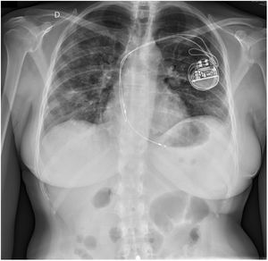 Chest X-rays imaging at admission.