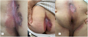 A. Placa liquenificada perianal con exulceración superficial y costra serosa en el glúteo derecho. B. Evolución a los tres meses de tratamiento con tretinoina tópica. C. Evolución a los seis meses con el tratamiento.