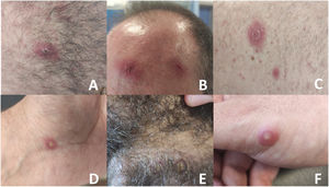 Lesiones dermatológicas de la infección por MPOX. En orden de aparición: A: Pústula sobreelevada en muslo del miembro inferior derecho B: Lesión costrosa en fase de resolución en zona frontoparietal izquierda C: Pápula bien delimitada en zona abdominal en hipocondrio derecho D: Vesícula de contenido purulento sin umbilicar en zona palmar de muñeca izquierda. E: Lesión costrosa en fase de resolución en zona genital F: Vesícula de contenido purulento sin umbilicar en dedo pulgar de mano derecha. Se realizaron PCR para MPOX en las vesículas de las imágenes D y F. MPOX: Monkeypox; PCR: reacción en cadena de la polimerasa.