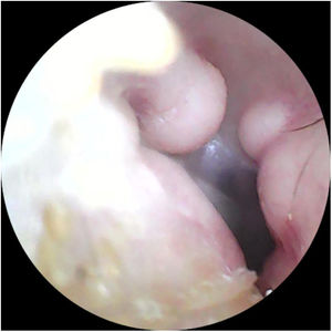 Lesiones excrecentes en conducto auditivo externo compatibles con exostosis de conducto auditivo externo.