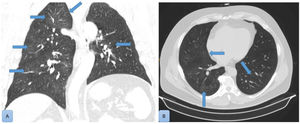 Tenues áreas parcheadas con densidad en vidrio deslustrado, de predominio en el lóbulo superior derecho, sugerentes de hemorragia alveolar.