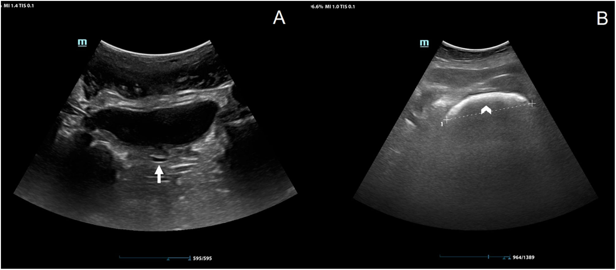 The rapid access to sonographic diagnosis of fecal impaction ...