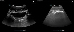Ultrasound of the rectum. (A) Normal rectal ampulla (arrow). (B) Diameter of the rectal ampulla, showing a fecal impaction (arrowhead).