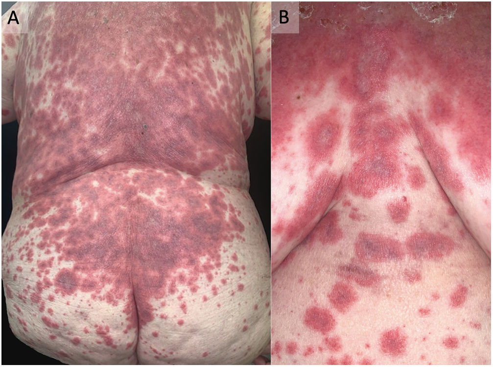 Targetoid Features Atypical targetoid lesions | Medicina de Familia. SEMERGEN