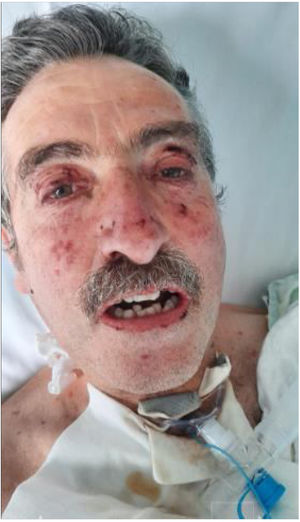 Eritema facial generalizado con edema periocular y pápulas dolorosas en regiones genianas que se desprenden al tacto. Además, se visualiza un enrojecimiento conjuntival bilateral. El cuero cabelludo está respetado. El paciente es portador de una cánula Shiley número 6 con balón para aislar la vía aérea debido al elevado riesgo de aspiraciones.