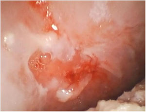 Ampollas dolorosas sobre base eritematosa en mucosa yugal que se desprende con el rascado. Signo de Nikolsky positivo.