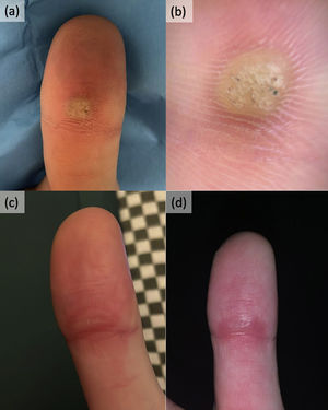Initial lesion presented as a papillomatous surface papule with dermatoscopy revealing red and black dots, consistent with viral wart (a and b). At 3 months of treatment (c) and 6 months of treatment (d), no signs of recurrence were observed.