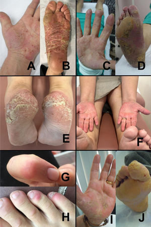 Lesiones en dermatosis palmoplantares no infecciosas. A,B)Pustulosis palmoplantar. Se observan múltiples lesiones pustulares y costras sobre base eritematosa en palma (A) y mayor compromiso con placas descamativas en plantas (B). C,D)Síndrome de Bazex, con lesiones papuloescamosas de base eritematosa en palma (C) y compromiso plantar extenso con hiperqueratosis (D). E,F)Dishidrosis con múltiples lesiones con collarete periférico sobre base eritematosa en talones (E) y pápulas costrosas rojizas en palmas (F). G,H)Eritema pernio con nódulo eritematovioláceo en dorso de dedo índice (G) y pápulas eritematosas en ortejos (H). I,J)Queratodermia palmoplantar con marcada hiperqueratosis difusa en palma (I) y planta con compromiso del hallux (J).