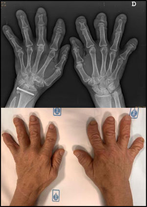 Se muestran las manos de la paciente, las cuales presentan dedos acortados, anchos y con pseudoacropaquias, y su correspondiente radiografía, donde puede observarse acroosteólisis de las falanges distales.