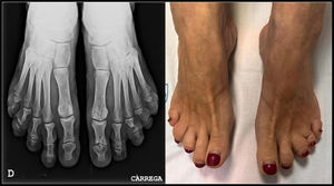 Imagen que muestra los pies de la paciente y su radiografía. Al igual que en las manos, nótese el acortamiento de los dedos afectados y la acroosteólisis de las falanges distales.