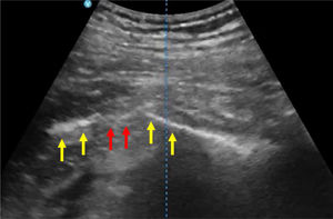 Imagen ecográfica de cadera con sonda convexa en el plano longitudinal. Se pueden visualizar dos líneas hiperecogénicas con sombra acústica posterior que corresponden a la cortical ósea del tercio proximal del fémur (flechas amarillas) y una discontinuidad (flechas rojas) compatible con una fractura. El color de las figuras solo puede apreciarse en la versión electrónica.
