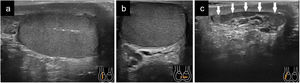 a) Corte longitudinal del testículo normal; b) Corte transversal. Obsérvese en «a» la línea hiperecogénica del mediastino testicular y en «b» la imágen hiperecogénica en la zona anterolateral que también corresponde al mediastino; c) Epidídimo normal.