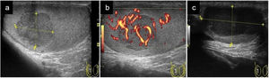 Cortes longitudinales de masas testiculares: a) Masa intratesticular homogénea e hipoecogénica (medida en ejes longitudinal y anteroposterior con línea discontinua amarilla) con diagnóstico anatomopatológico de seminoma; b) Imagen a con captación Doppler color; c) Masa que ocupa la práctica totalidad del teste (medido en ejes longitudinal y anteroposterior con línea discontinua amarilla) hipoecogénica con diagnóstico anatomopatológico de linfoma.