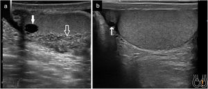 a) Quiste intratesticular (flecha sólida). Ectasia del rete testis (flecha hueca); b) Quiste en cabeza de epidídimo (señalado con flecha).